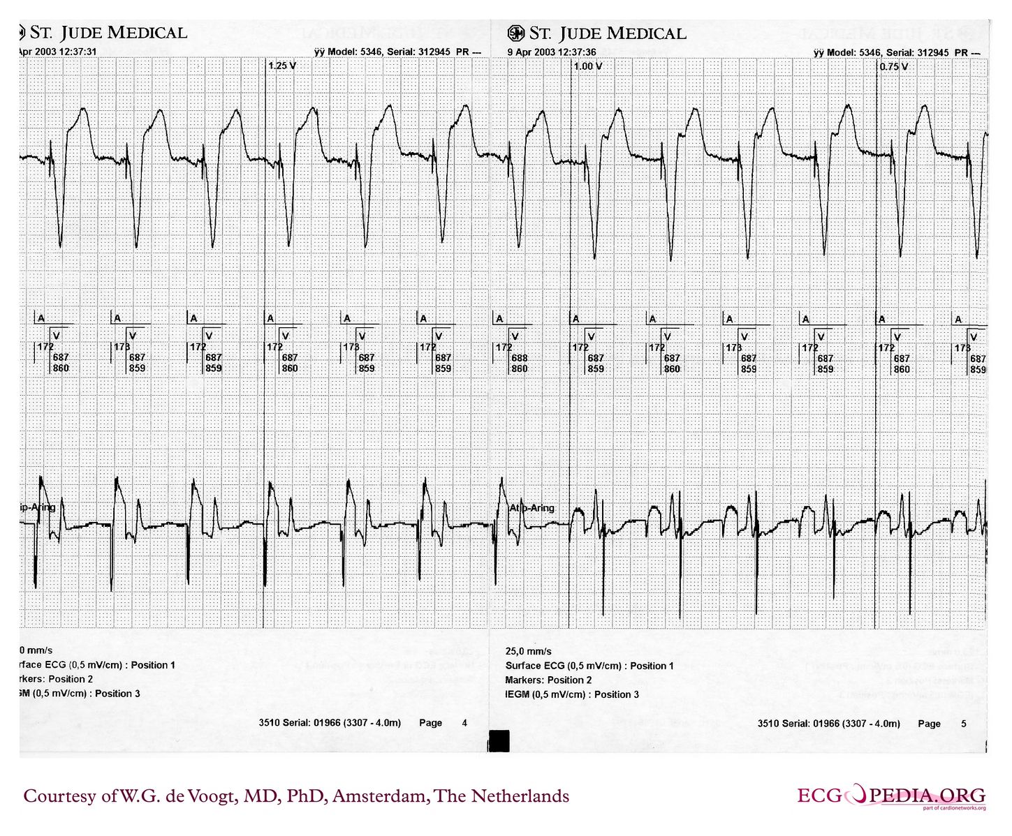 File:DVA0986.jpg - ECGpedia