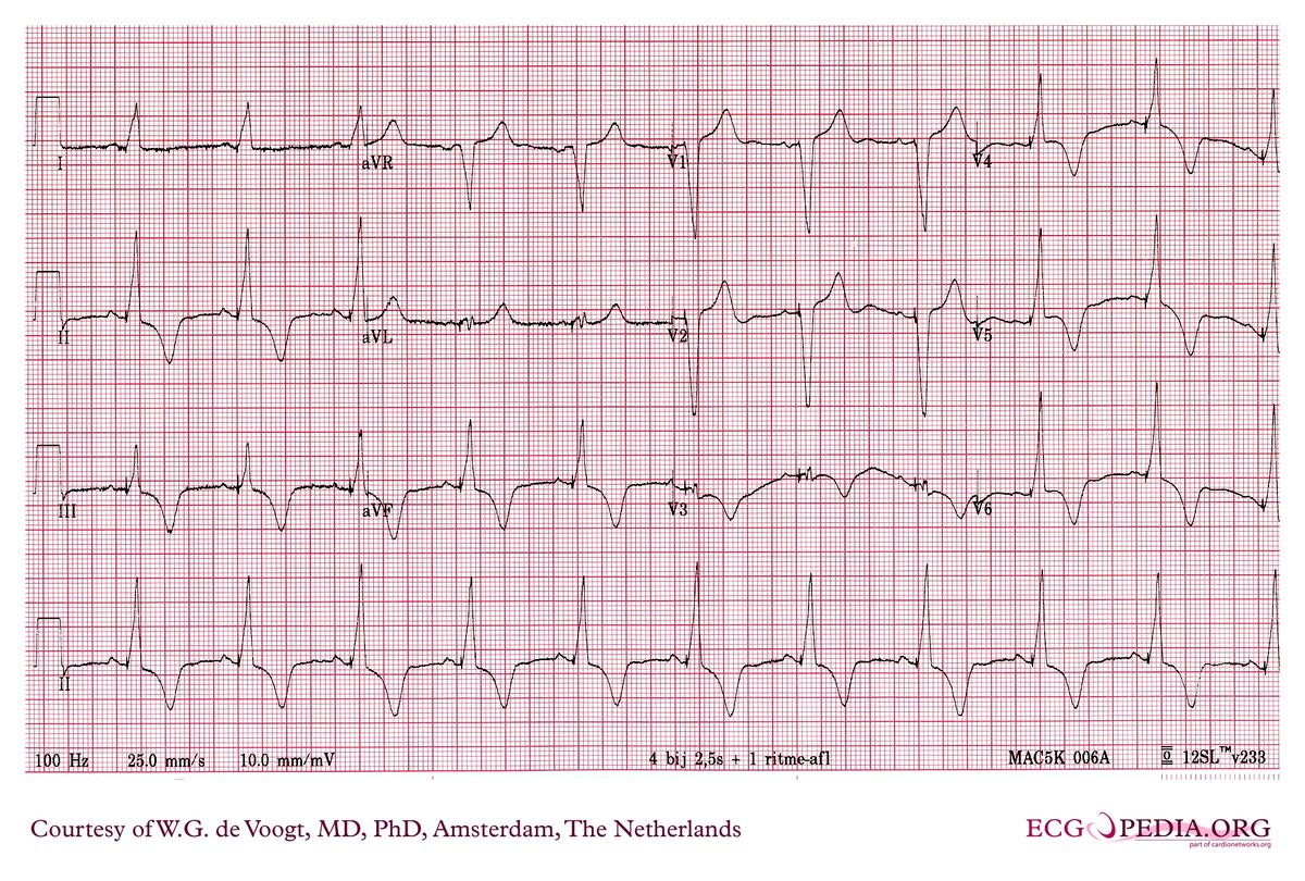 File:DVA1460.jpg - ECGpedia