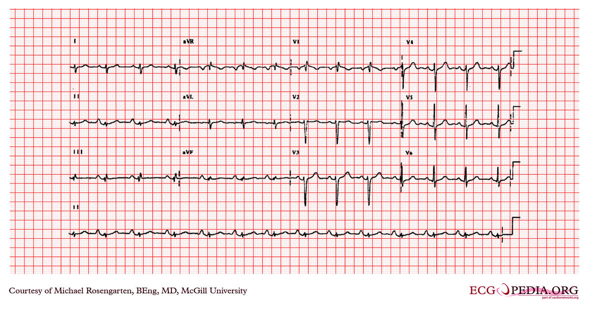 McGill Case 335 - ECGpedia