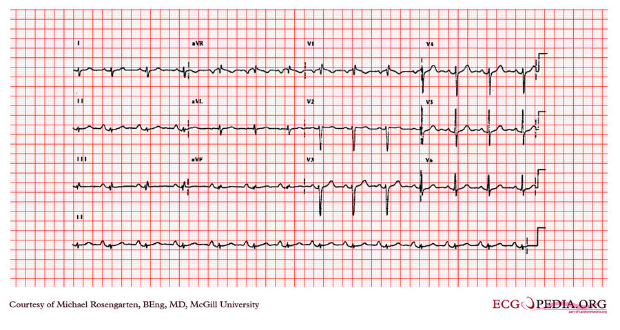 McGill Case 335 - ECGpedia