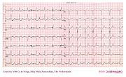 De Voogt ECG Archive - Supraventricular Rhythms - WPW - ECGpedia