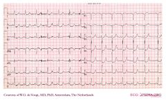 De Voogt ECG Archive - Supraventricular Rhythms - WPW - ECGpedia