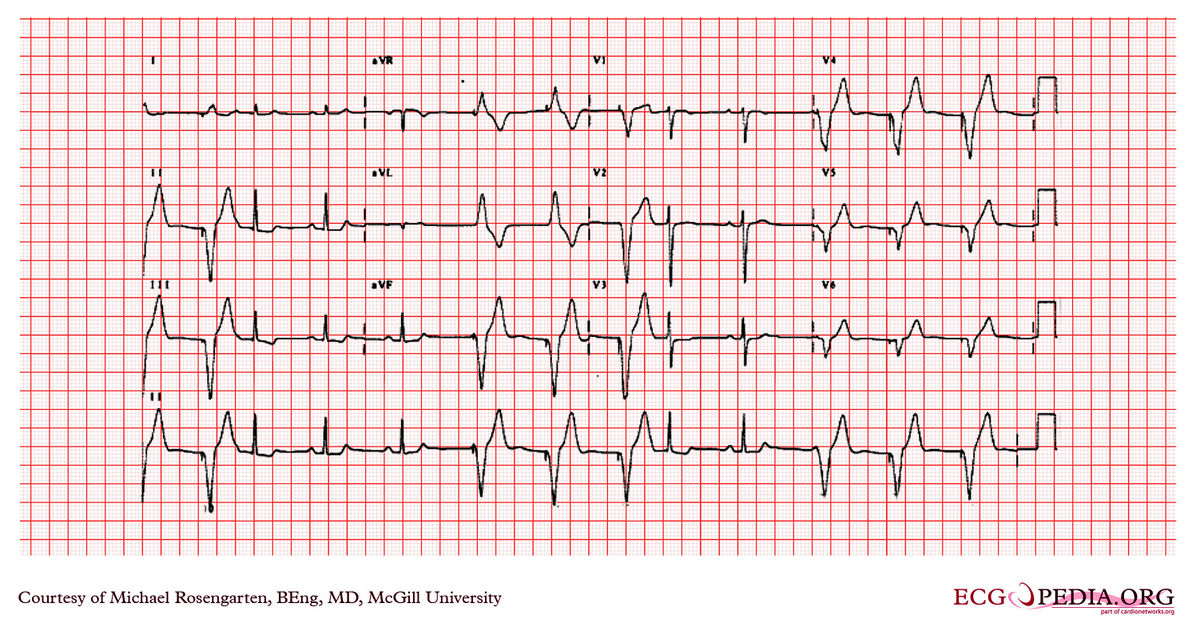 McGill Case 208 - ECGpedia