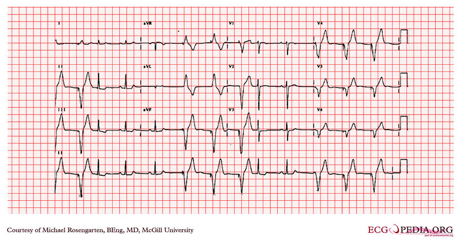 McGill Case 208 - ECGpedia