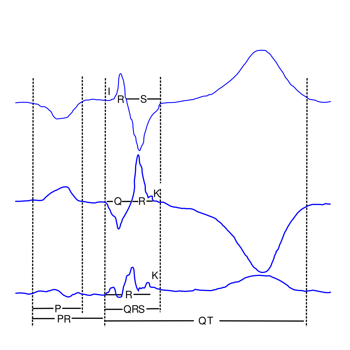 File:Projects repolarization 2.svg - ECGpedia