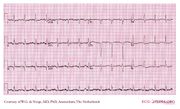 De Voogt ECG Archive - Electrolyte Disorders - ECGpedia