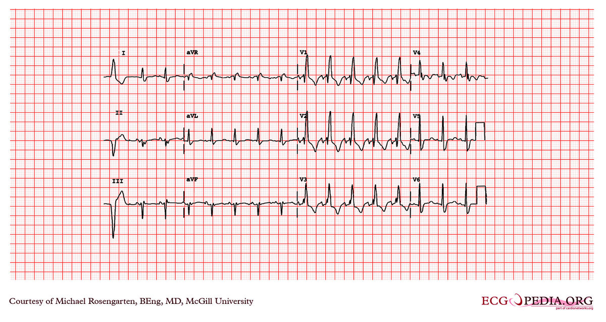 McGill Case 76 - ECGpedia