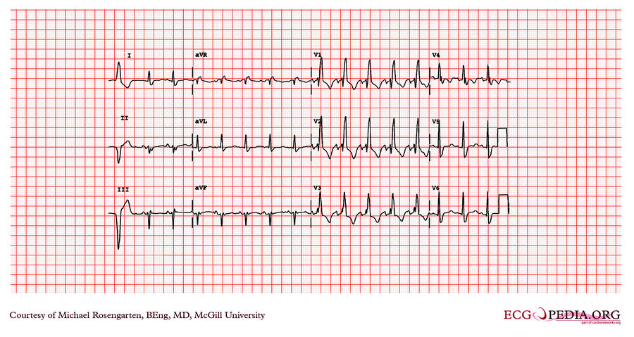 McGill Case 76 - ECGpedia