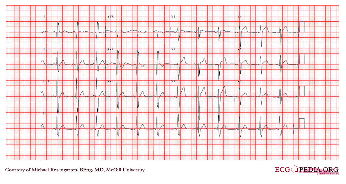 McGill Case 368 - ECGpedia