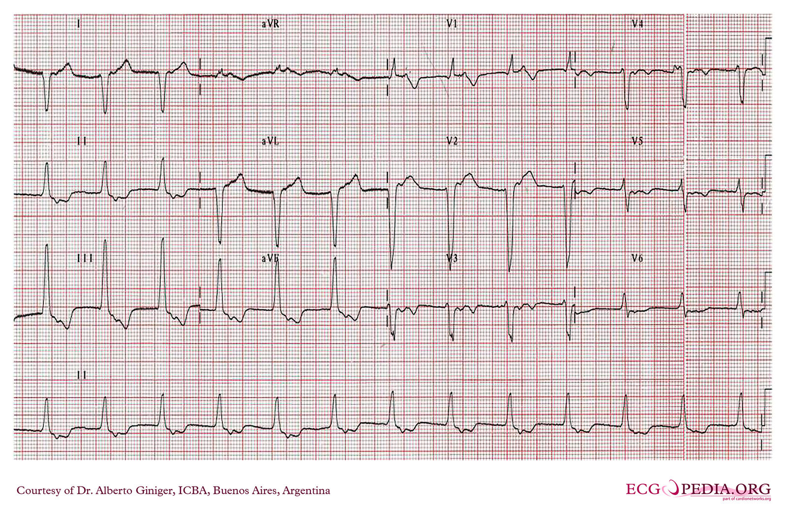 File:ICBA00013.jpg - ECGpedia