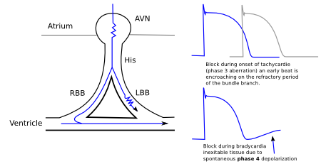 Intraventricular Conduction - ECGpedia