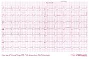 De Voogt ECG Archive - Intraventricular Conduction - ECGpedia