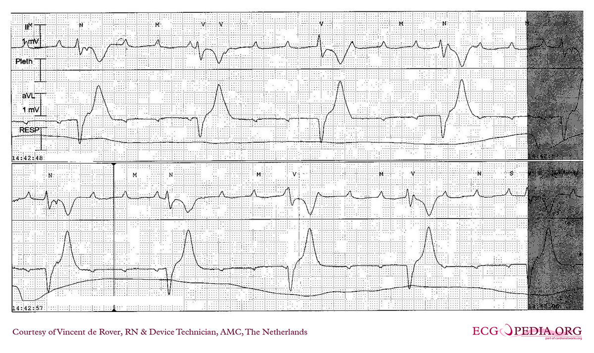 AMC Case 190 - ECGpedia