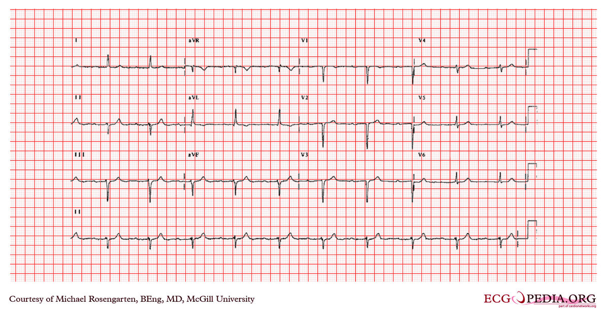 File:E362.jpg - ECGpedia