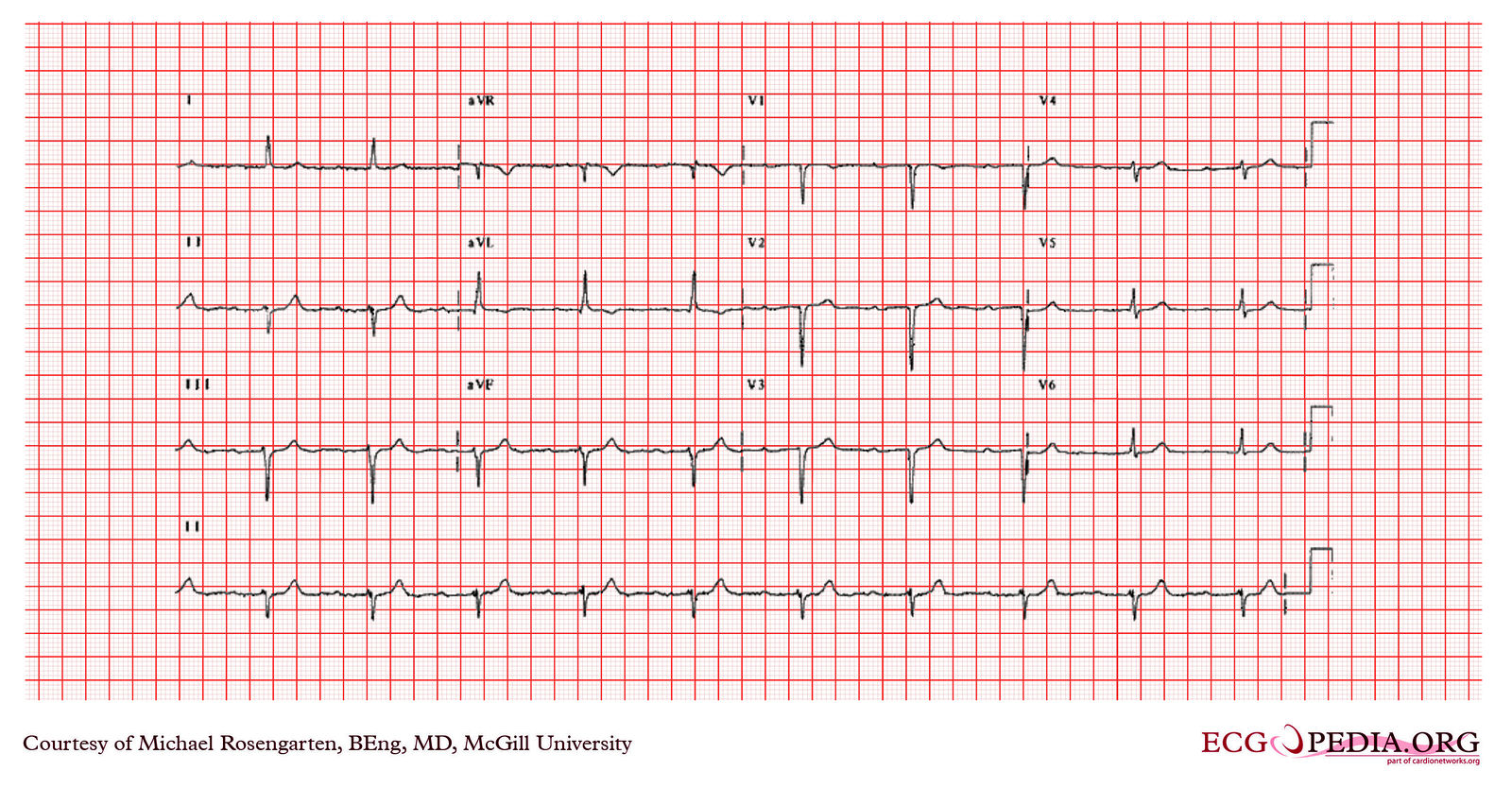 File:E362.jpg - ECGpedia