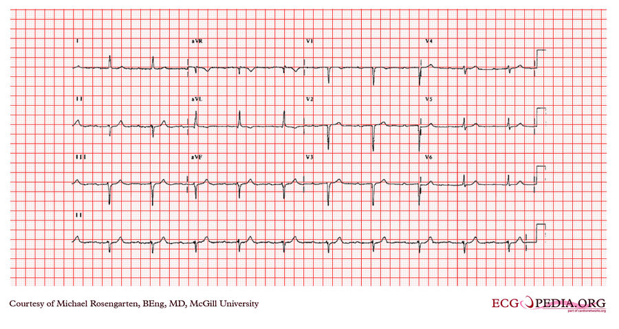 McGill Case 362 - ECGpedia