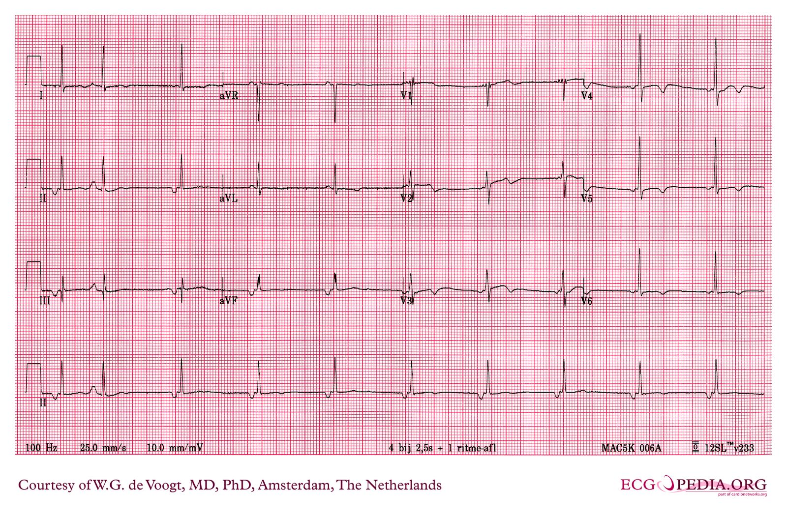 File:DVA0241.jpg - ECGpedia