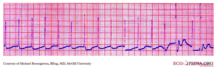 McGill Case 161 - ECGpedia