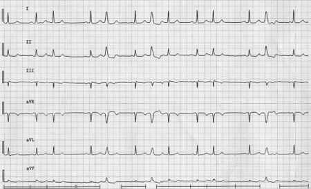 Answer 2008 05 - ECGpedia