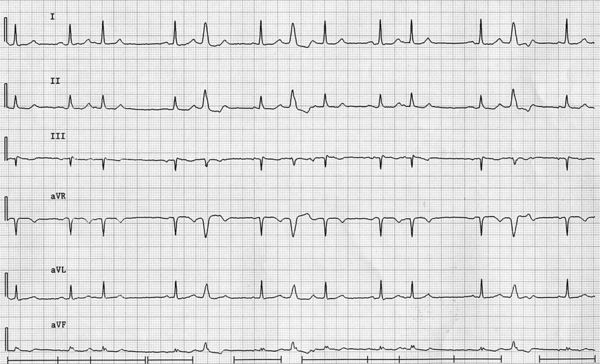 Wide Complexes Intervening Regular Sinus Rhythm - 4 - Ecgpedia