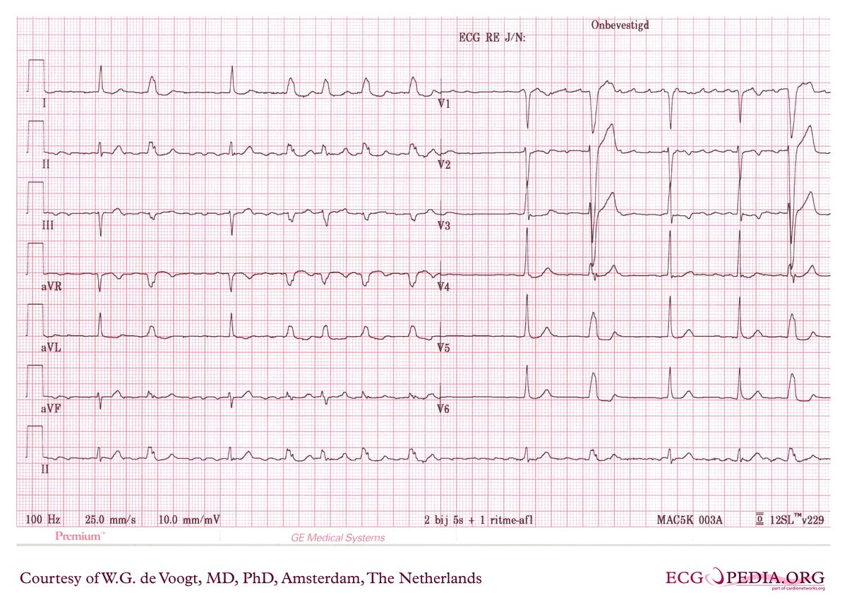 File:DVA0752.jpg - ECGpedia