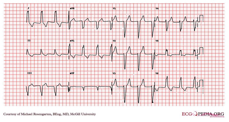 McGill Case 11 - ECGpedia