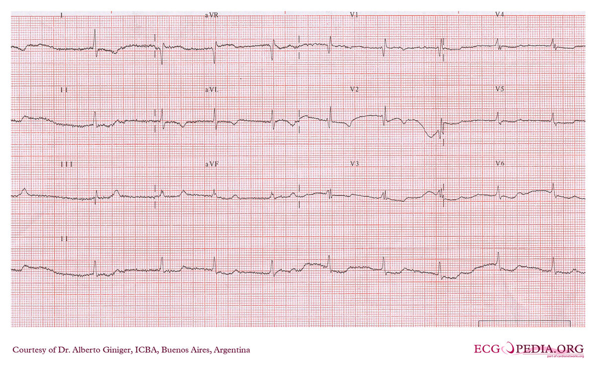 ICBA25 - ECGpedia