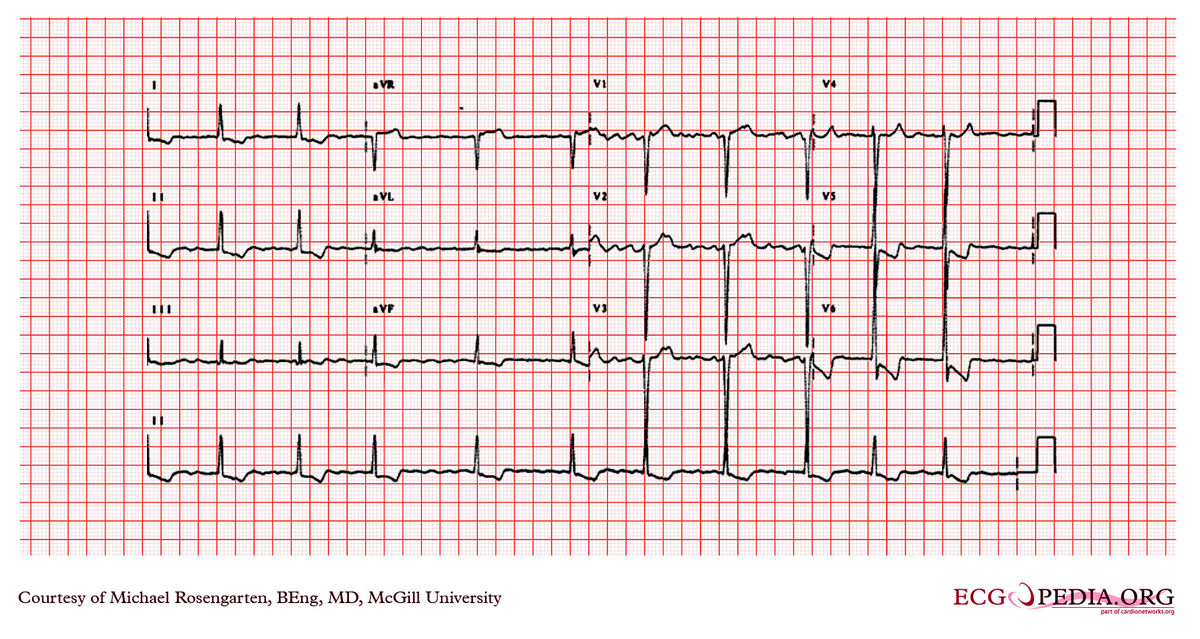 File:E199.jpg - ECGpedia