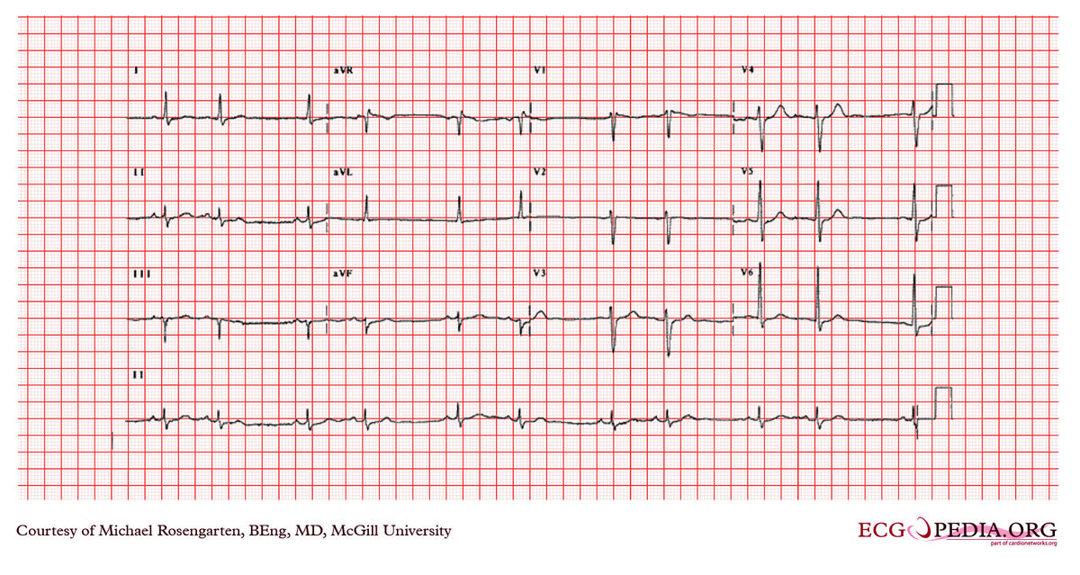 McGill Case 380 - ECGpedia