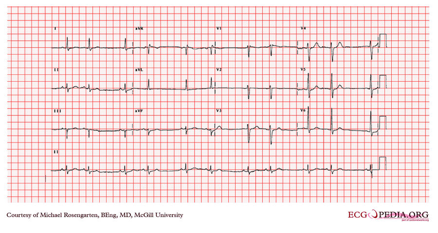 McGill Case 380 - ECGpedia