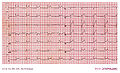 Acute pericarditis with clear diffuse ST elevation and some PTa depression