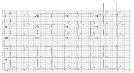 Puzzle 2005 4 156 - Answer - ECGpedia