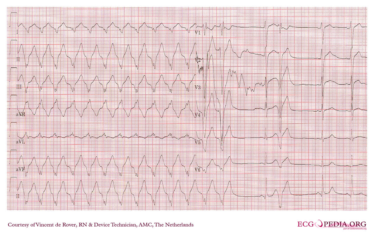 AMC Case 118 - ECGpedia