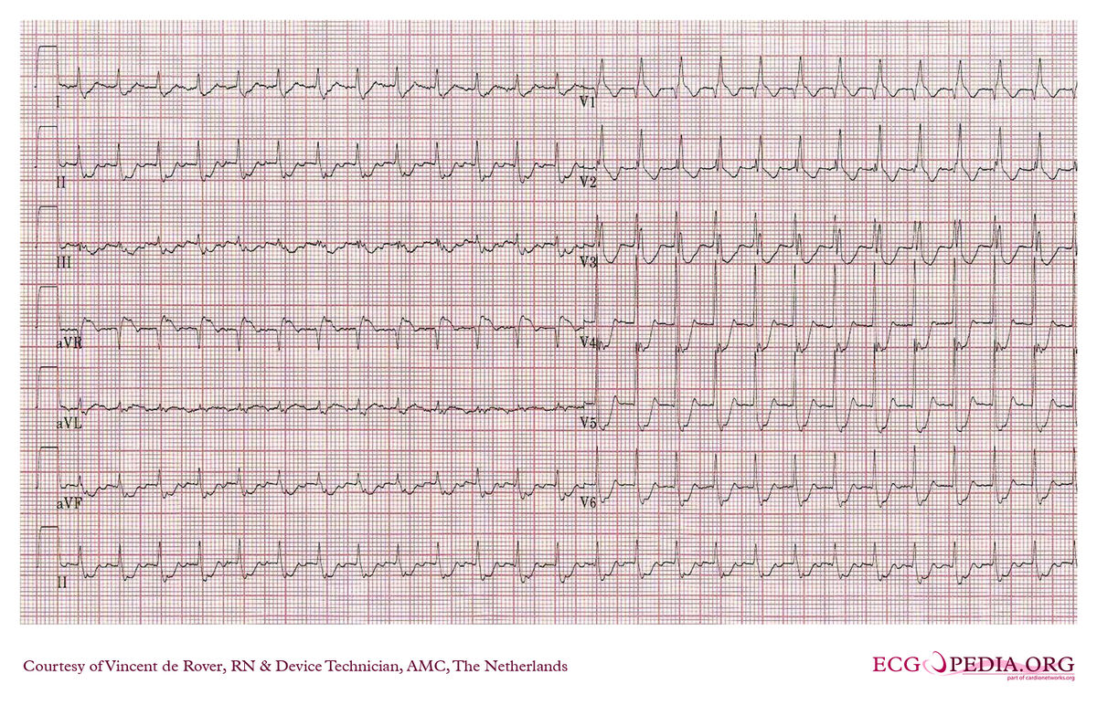 AMC Case 209 - ECGpedia