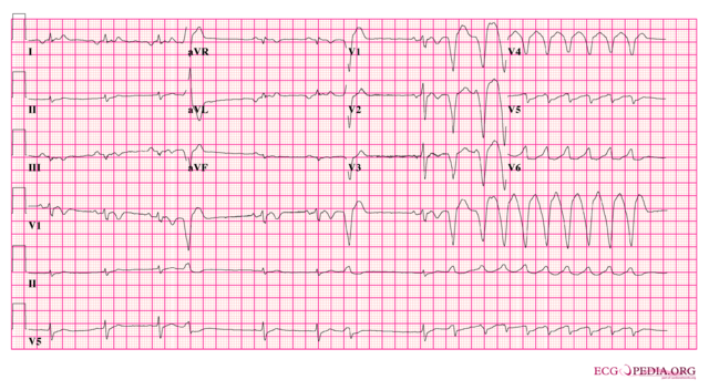 File:Arvd ecg2.png - ECGpedia