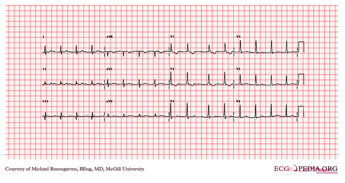 mcgill-case-263-ecgpedia