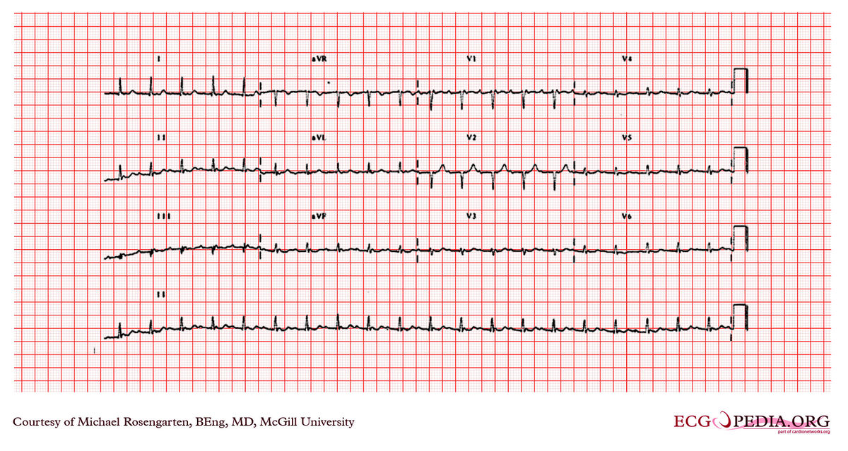 McGill Case 272 - ECGpedia