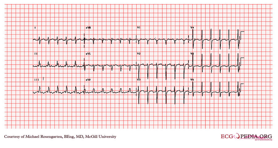 Mcgill Case 344 - Ecgpedia