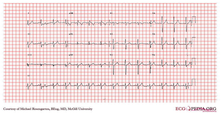 McGill Case 359 - ECGpedia