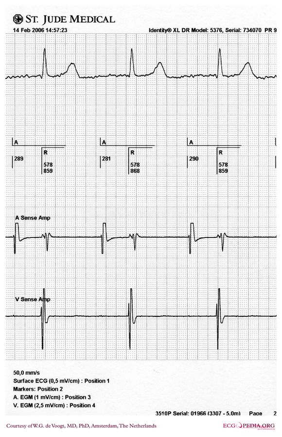 File:DVA1239.jpg - ECGpedia