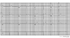 Chamber Hypertrophy and Enlargment - ECGpedia