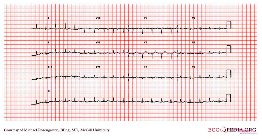 McGill Case 57 - ECGpedia