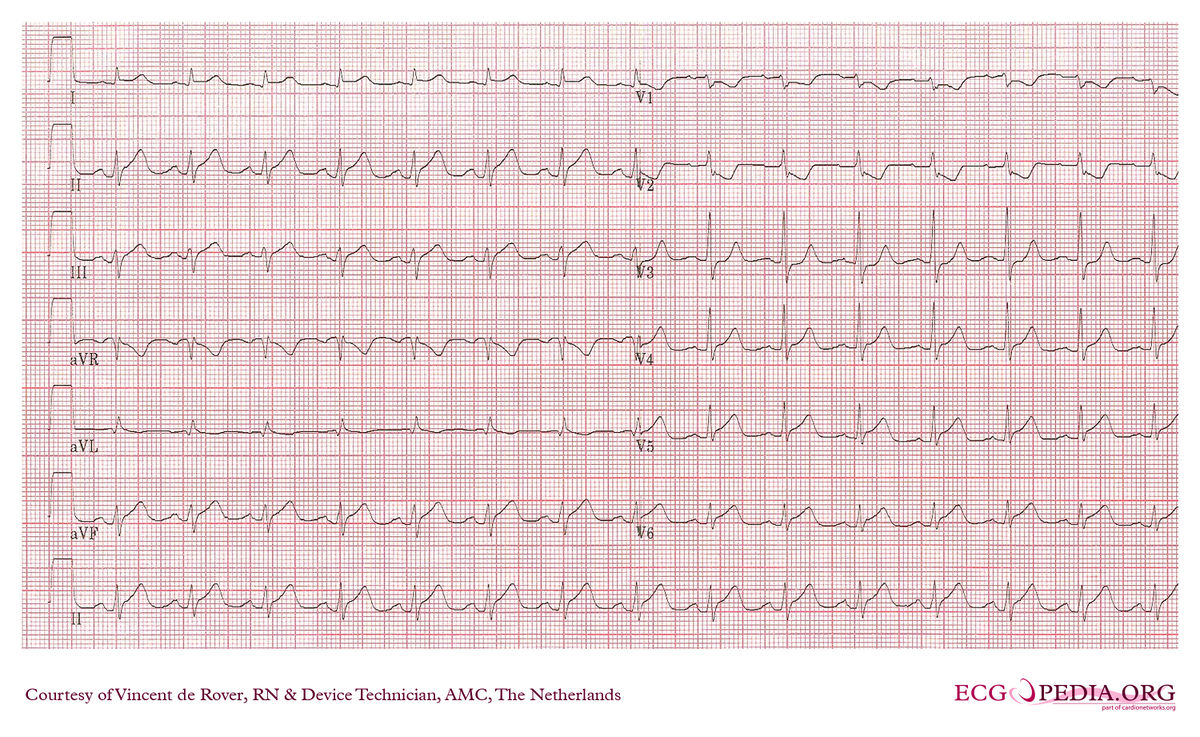 AMC Case 56 - ECGpedia