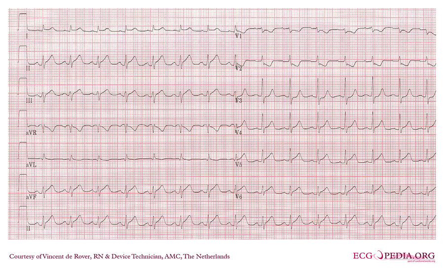 AMC Case 56 - ECGpedia