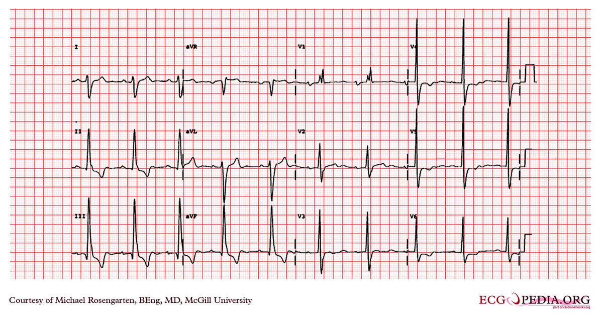 McGill Case 27 - ECGpedia