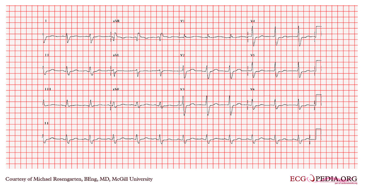 McGill Case 364 - ECGpedia