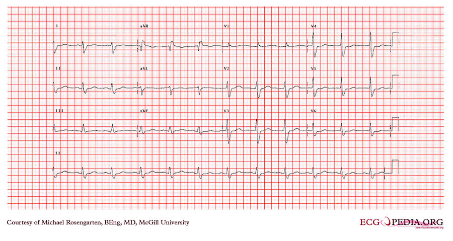 McGill Case 364 - ECGpedia