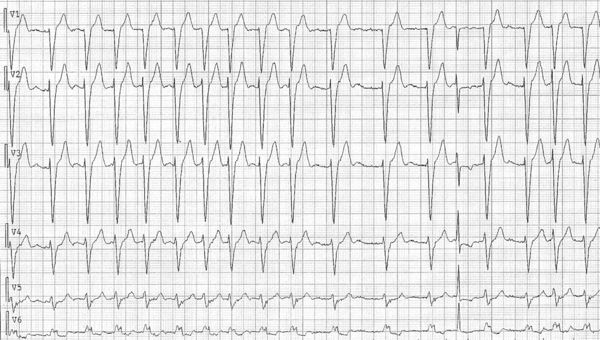 Puzzle 2009 08 Answer - Ecgpedia