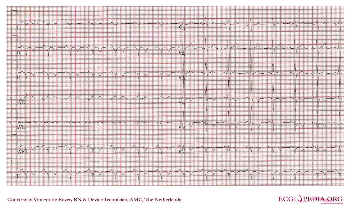 AMC Case 20 - ECGpedia