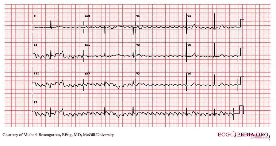 McGill Case 64 - ECGpedia